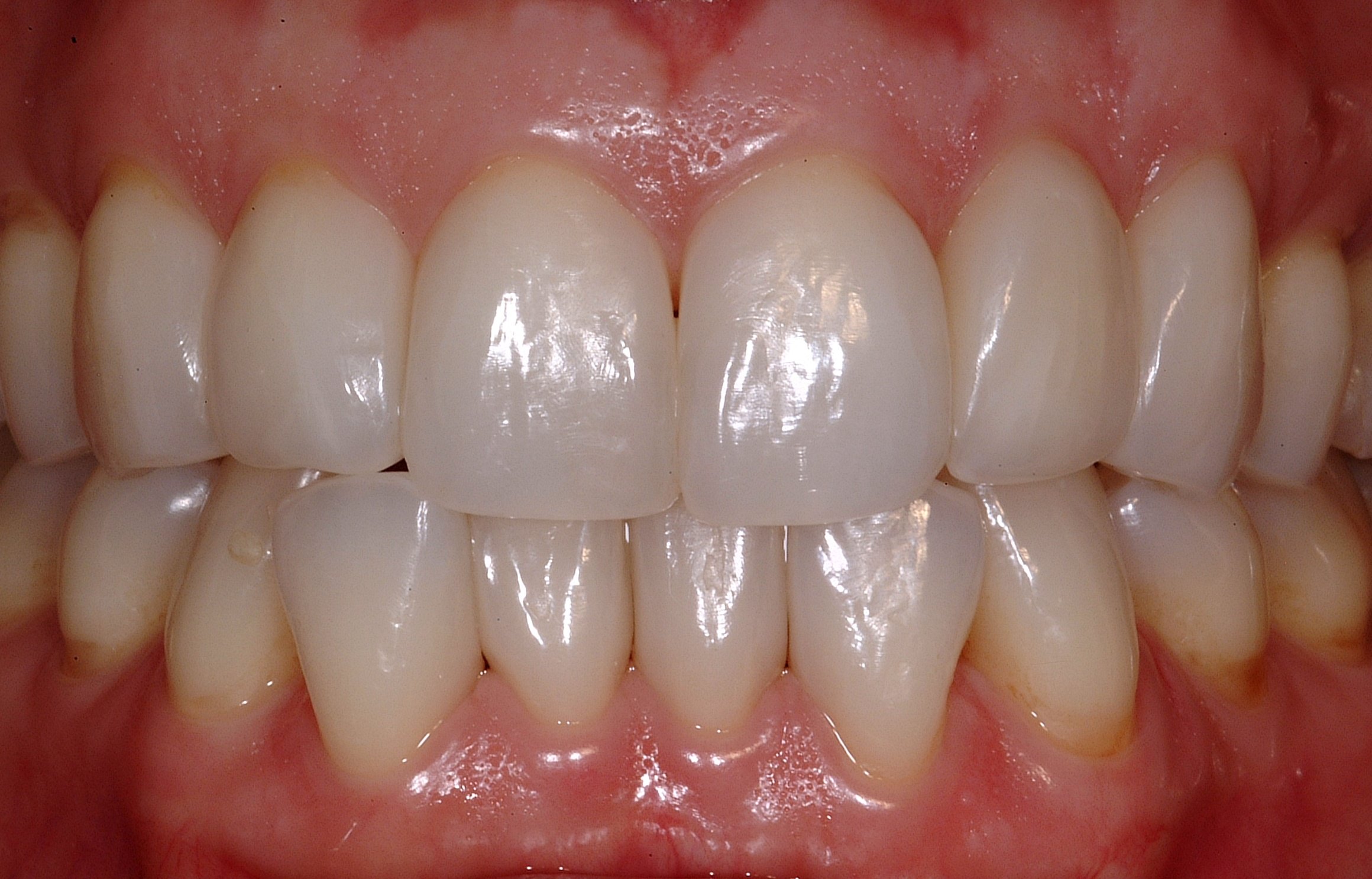 Closing the Gap in Direct Dentistry Treating Black Triangles Optident